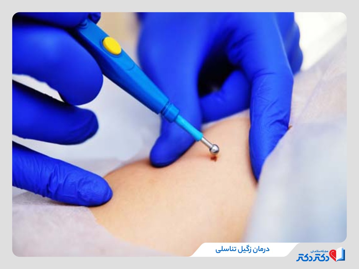 لیزر زگیل تناسلی