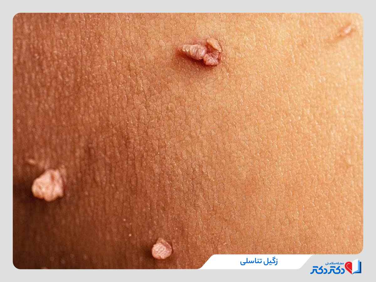 شکل زگیل تناسلی