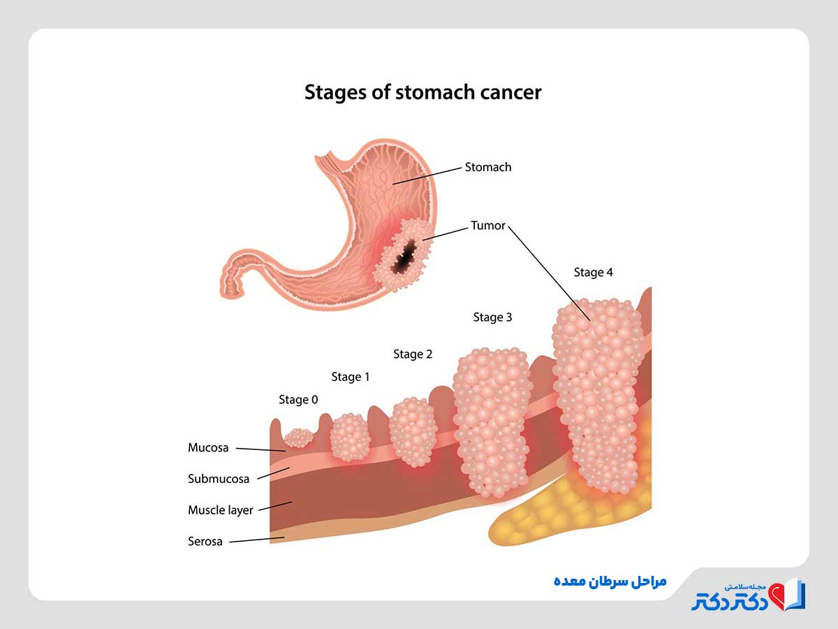 تصویر مراحل پیشروی سرطان معده