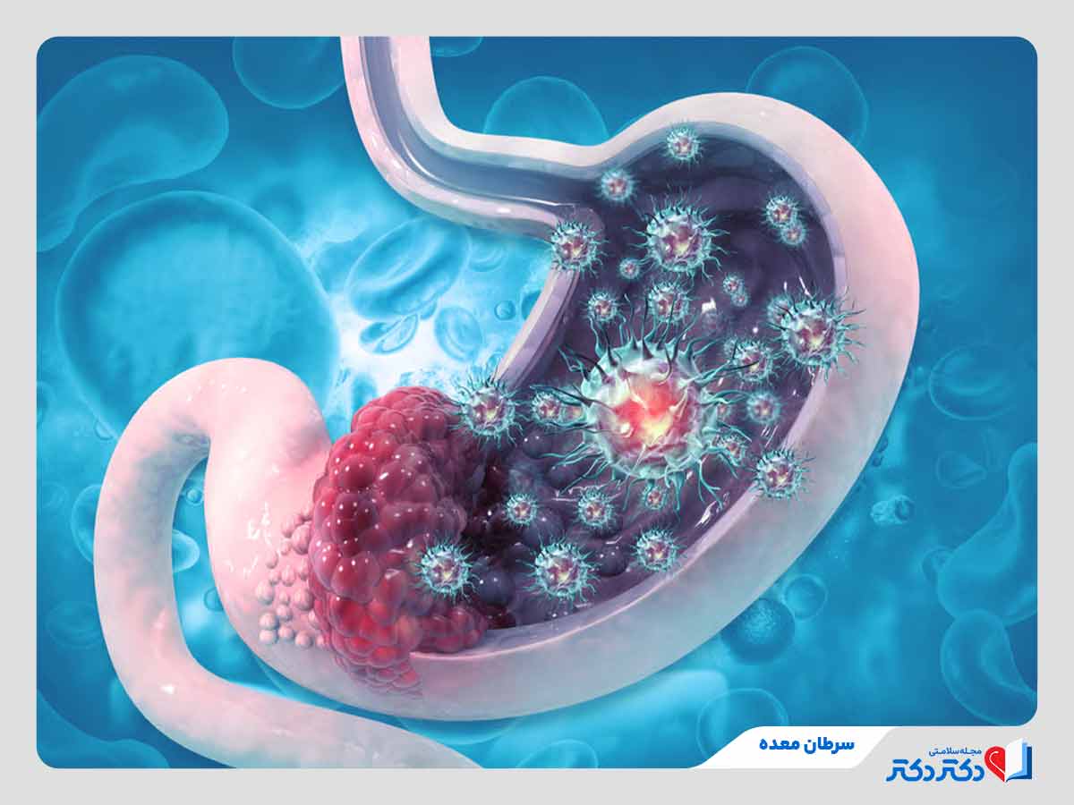 فرد مبتلا به سرطان معده
