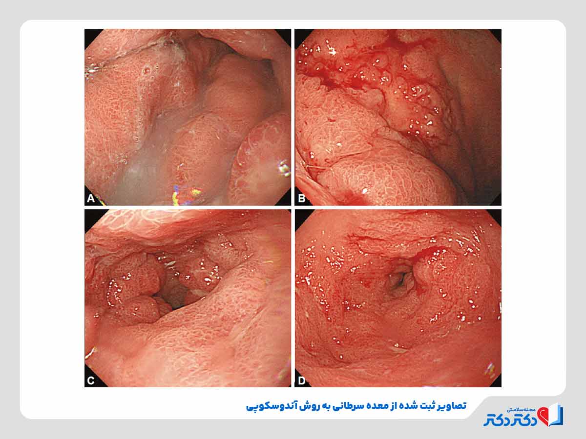 تصاویر آندوسکوپی معده فرد مبتلا به سرطان معده