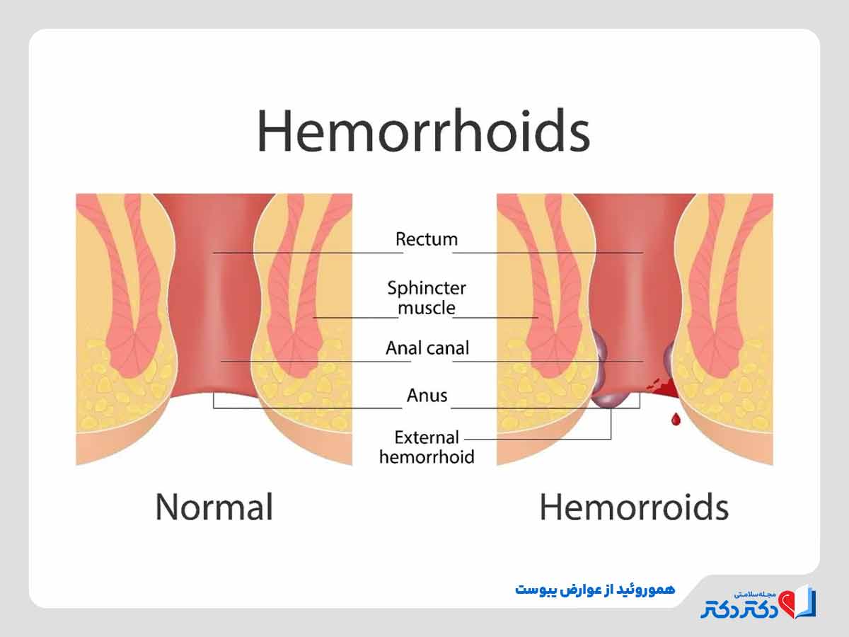 تصویر هموروئید در اثر ابتلا به یبوست