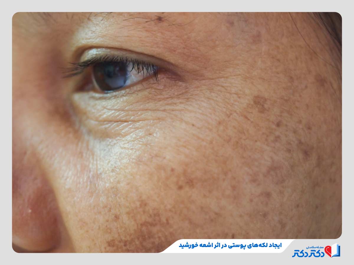 زن مبتلا به لکه‌های پوستی در اثر قرار گرفتن در برابر نور خورشید با شاخص فرابنفش شدید