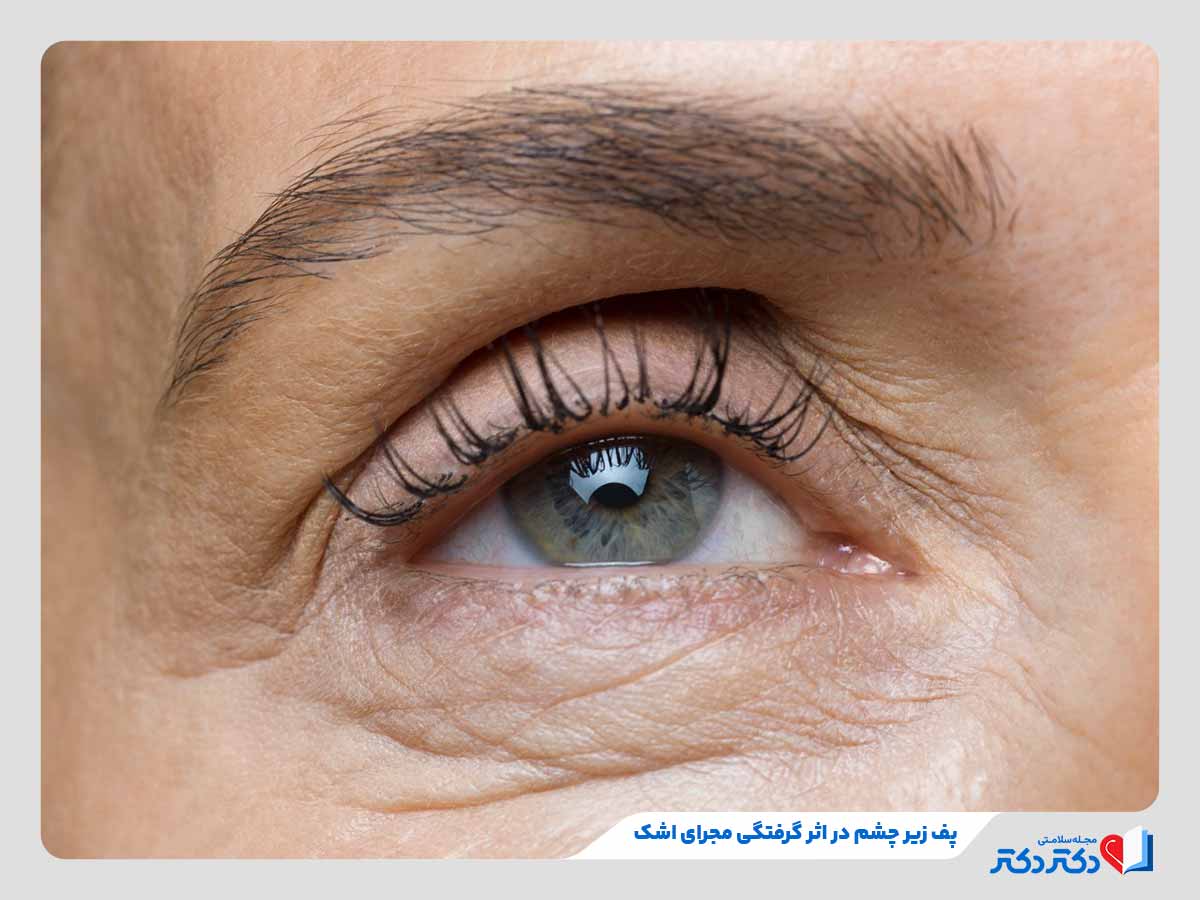 پف زیر چشم چیست؟ 12 علت پف چشم + راه حلهای سریع درمان خانگی_رنگو 4 فرد مبتلا به پف زیر چشم در اثر گرفتگی مجرای اشک
