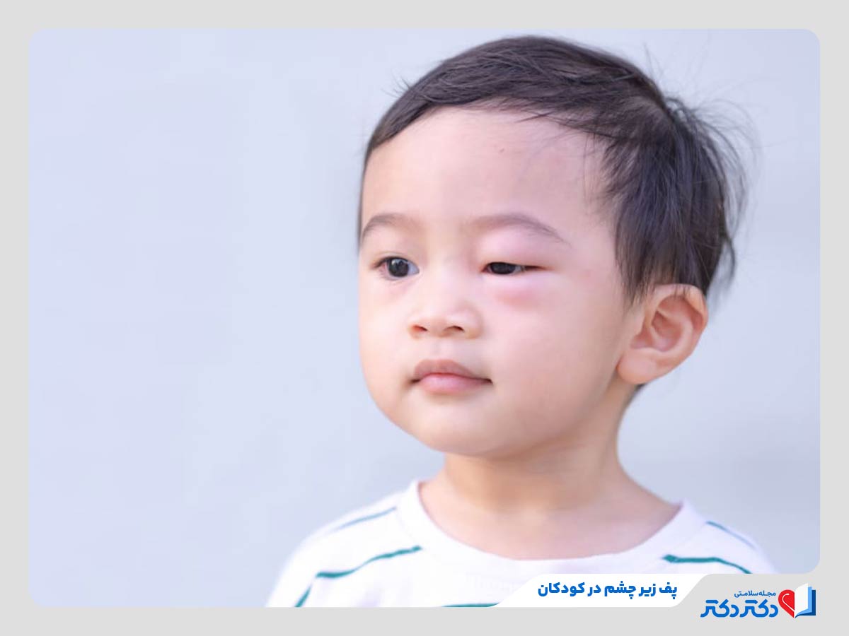 پف زیر چشم چیست؟ 12 علت پف چشم + راه حلهای سریع درمان خانگی_رنگو 20 کودک مبتلا به پف زیر چشم