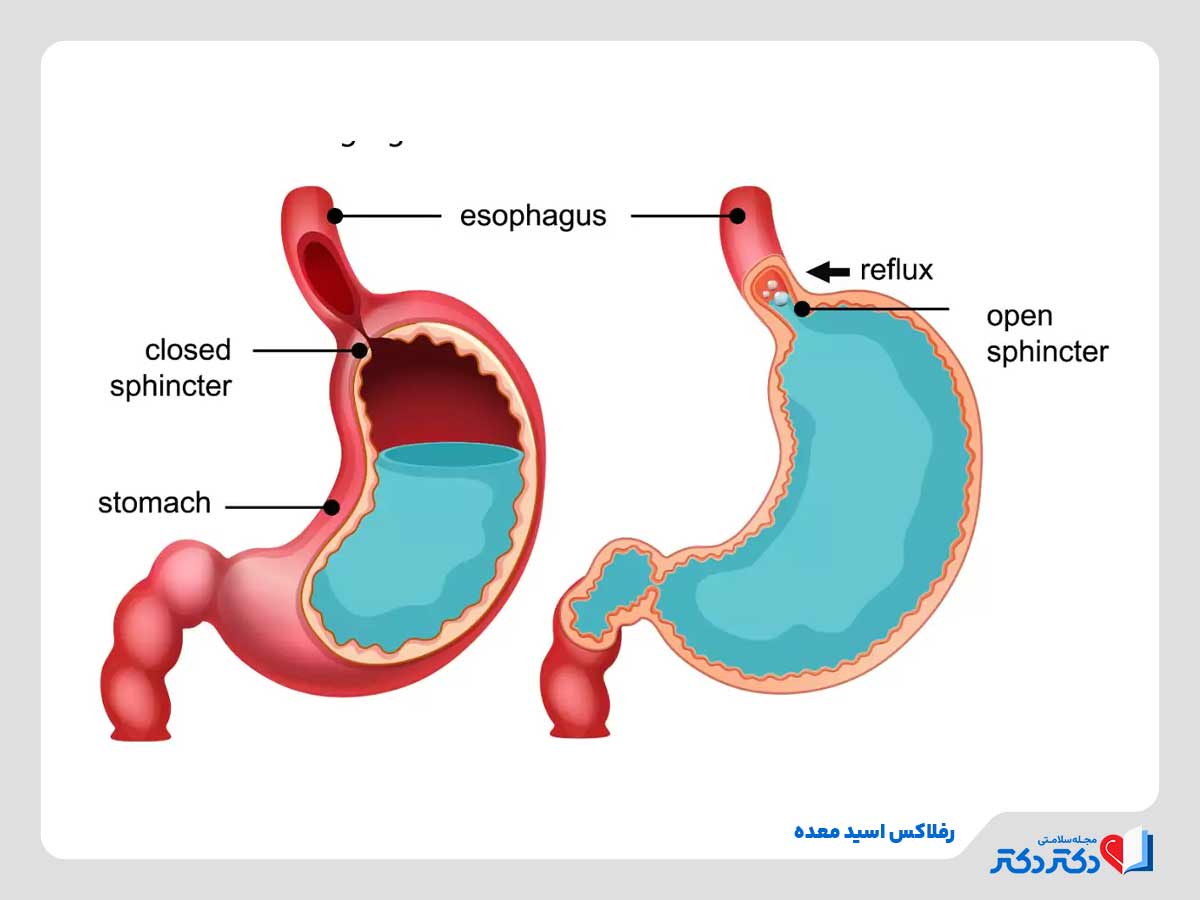 سوزش معده چیست؟ + موثرترین راه حلهای درمان_رنگو 12 تصویر رفلاکس معده از عوامل اصلی سوزش معده