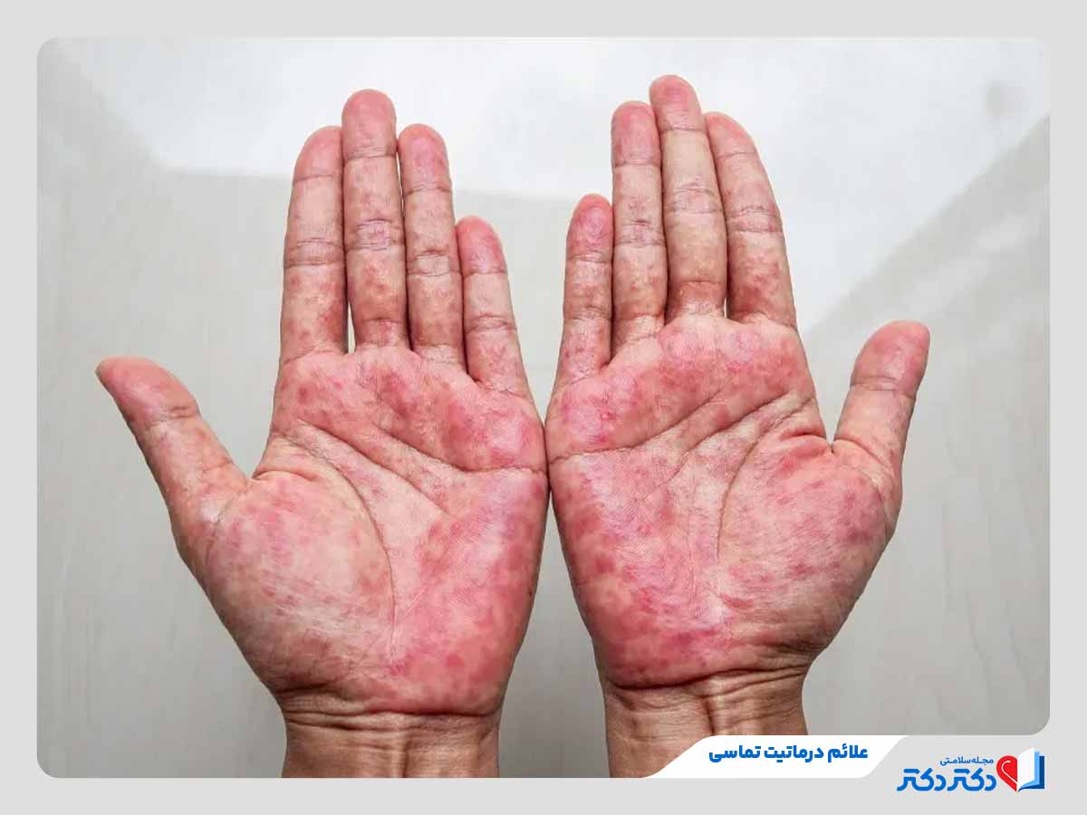 درماتیت تماسی چیست؟ + علائم، علل و راه حلهای درمان آن_رنگو 2 فرد مبتلا به قرمزی، تورم و خارش کف دست در اثر درماتیت تماسی