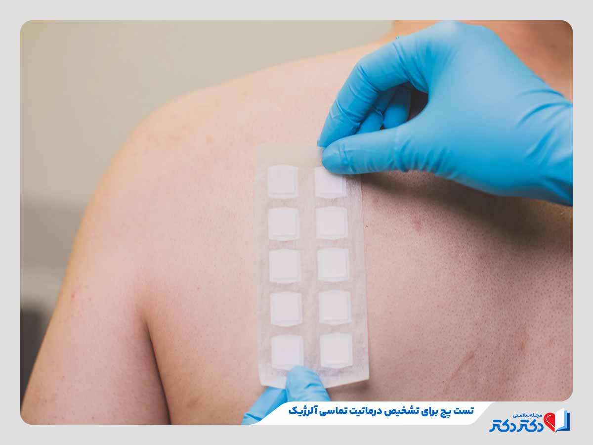درماتیت تماسی چیست؟ + علائم، علل و راه حلهای درمان آن_رنگو 4 دکتر در حال انجام تست پچ برای تشخیص درماتیت تماسی آلرژیک