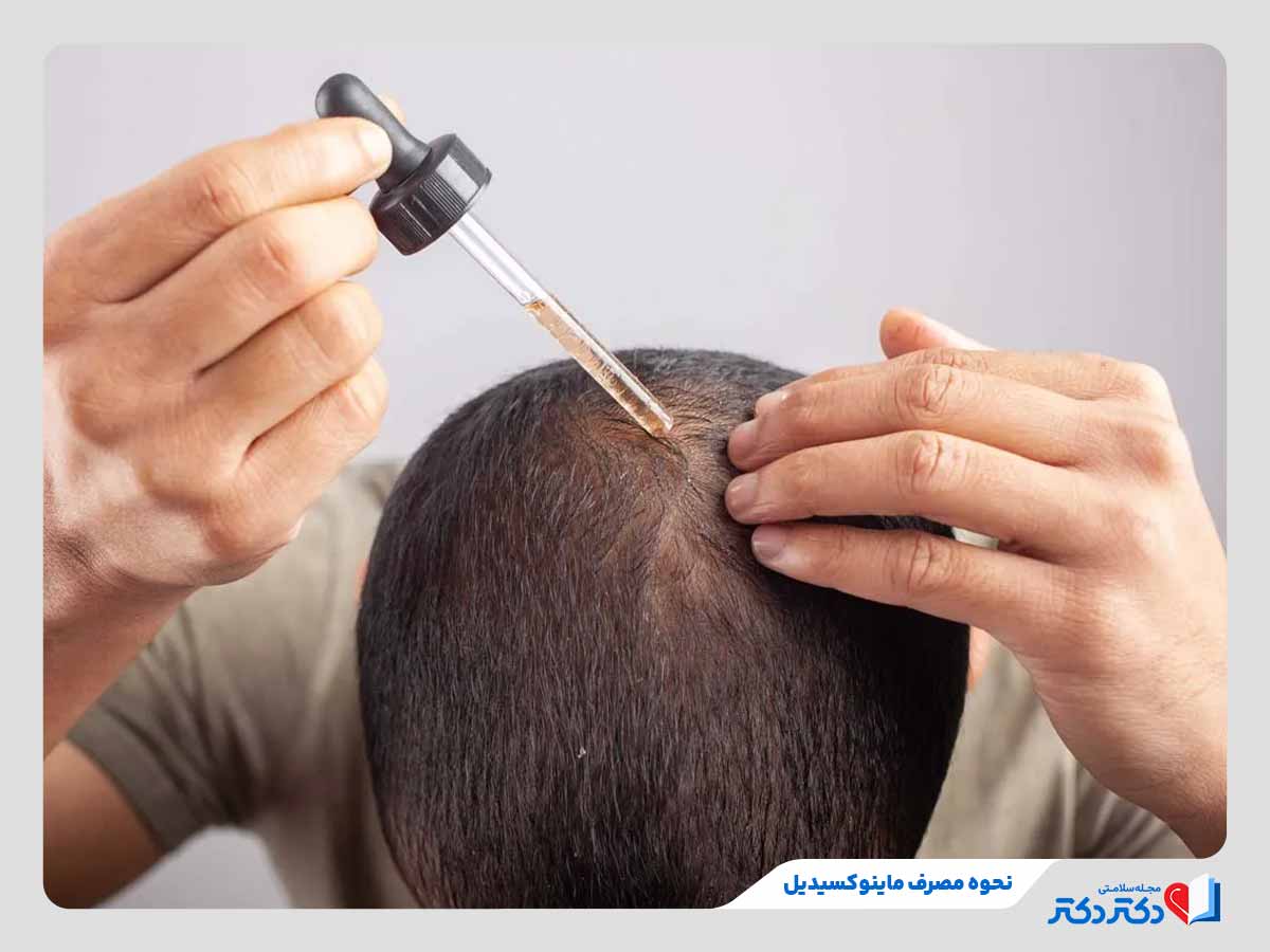ماینوکسیدیل چیست؟ همه چیز درمورد این دارو برای رشد مو_رنگو 4 فرد در حال استفاده درست از محلول ماینوکسیدیل