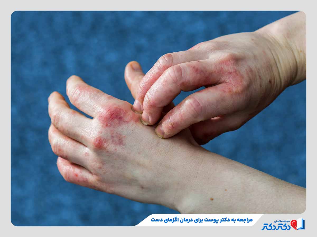 فرد نیازمند به مراجعه به دکتر به دلیل تشدید علائم درماتیت دست