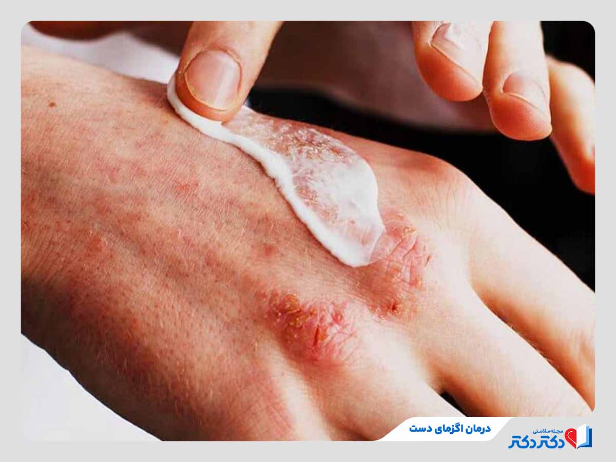 فرد در حال درمان اگزمای دست با کرم مرطوب‌کننده
