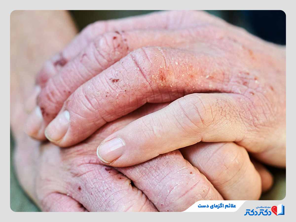 فرد مبتلا به ترک خوردگی و خشکی پوست به دلیل اگزمای دست