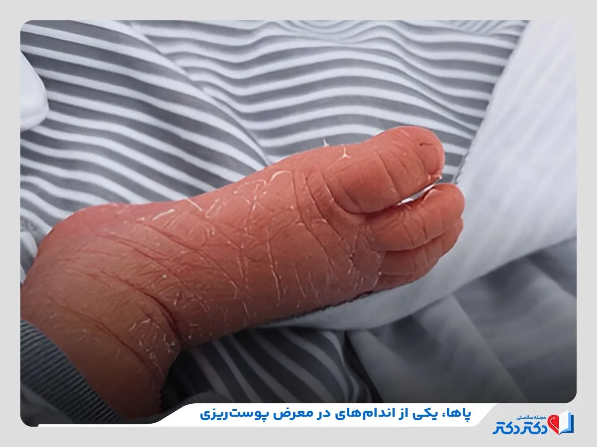 پررسی اندام‌های در معرض پوست‌ریزی 