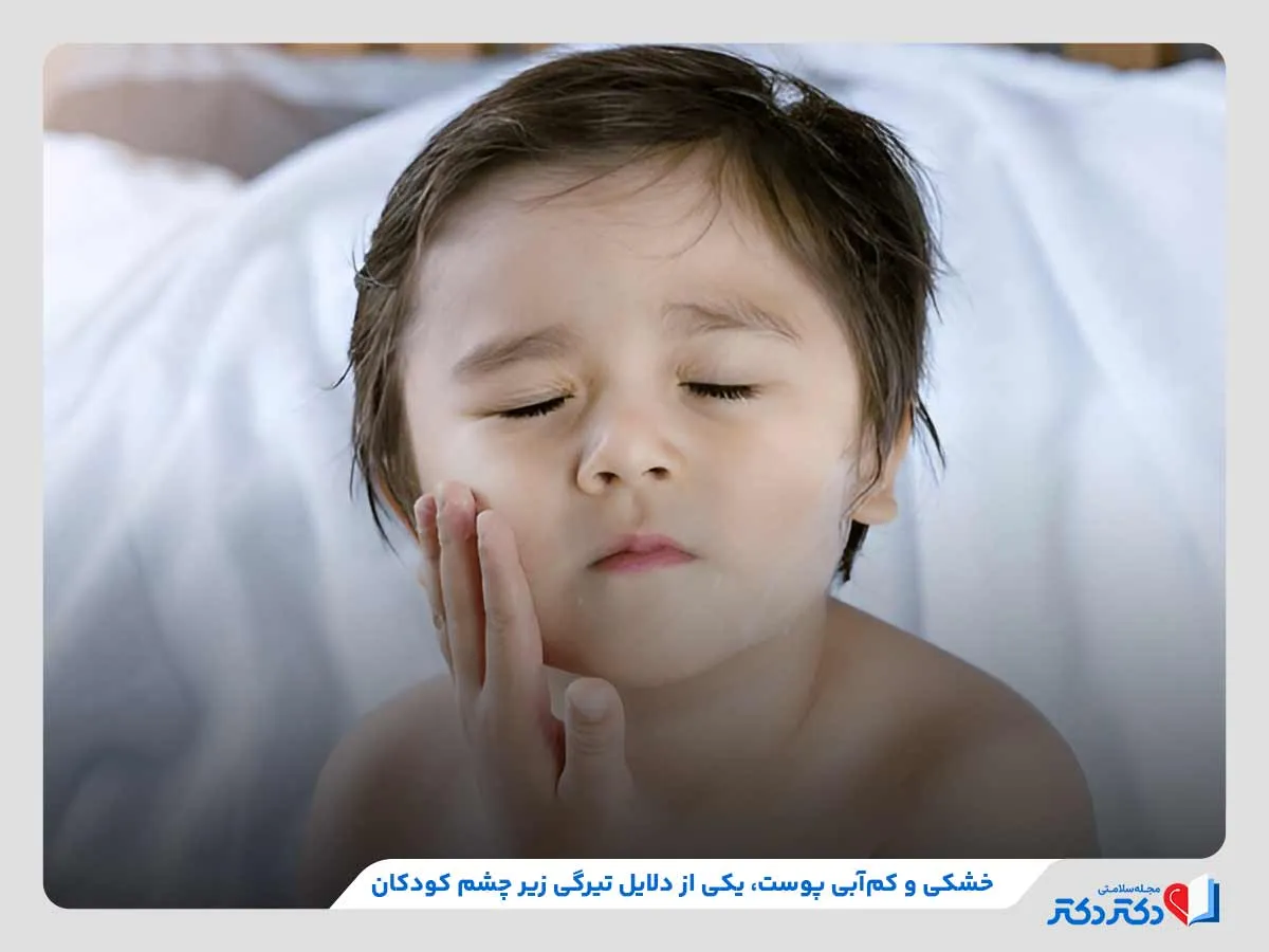 سیاهی زیر چشم در نتیجه خشکی و کم‌آبی پوست کودک