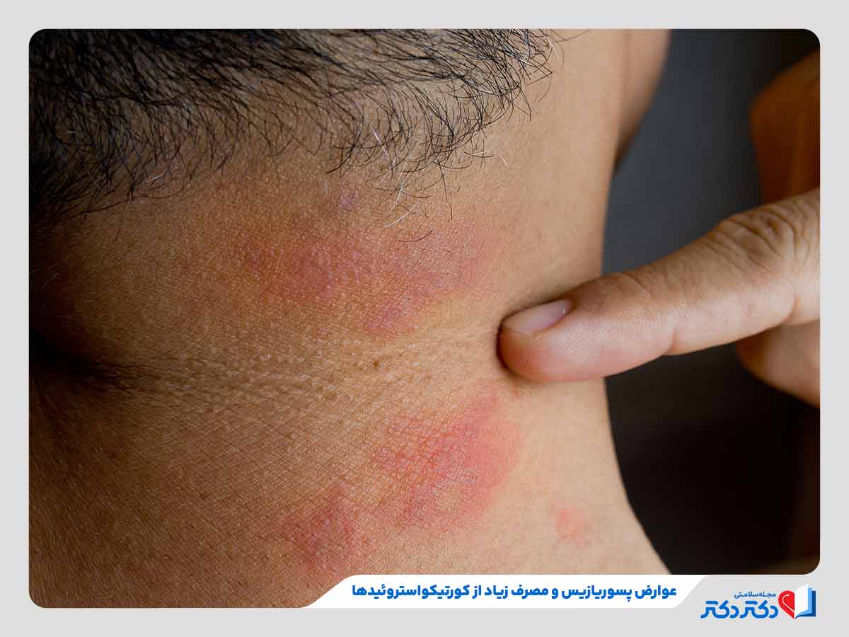 پسوریازیس چیست و چطور درمان میبشود؟ + علل و علائم_رنگو 10 نازک شدن پوست گردن فرد به دلیل استفاده از داروهای پسوریازیس