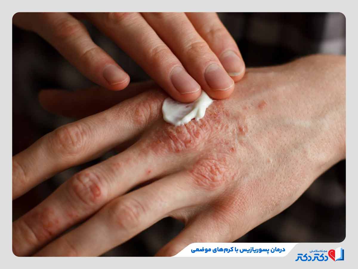 فرد در حال درمان پسوریازیس با کرم های موضعی