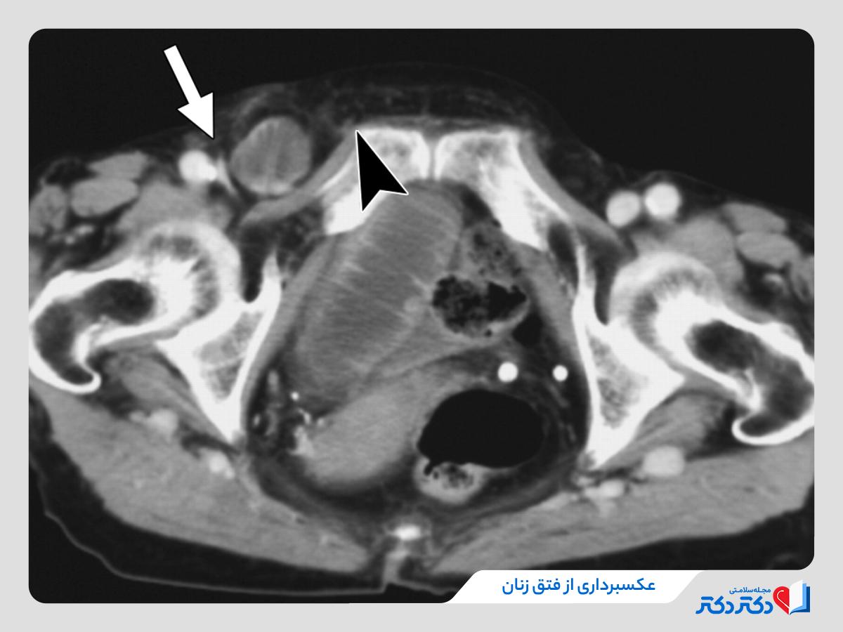 عکسبرداری از باد فتق زنان