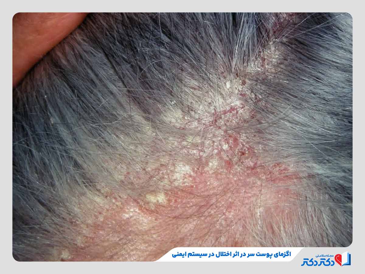 اگزمای پوست سر: علائم، علل، تشخیص و بهترین روشهای درمان و پیشگیری 6 فرد مبتلا به درماتیت تماسی پوست سر در اثر اختلالات سیستم ایمنی