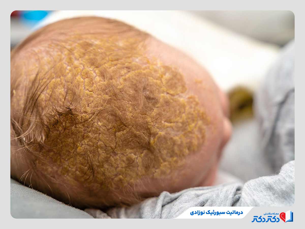 نوزاد مبتلا به اگزمای پوست سر