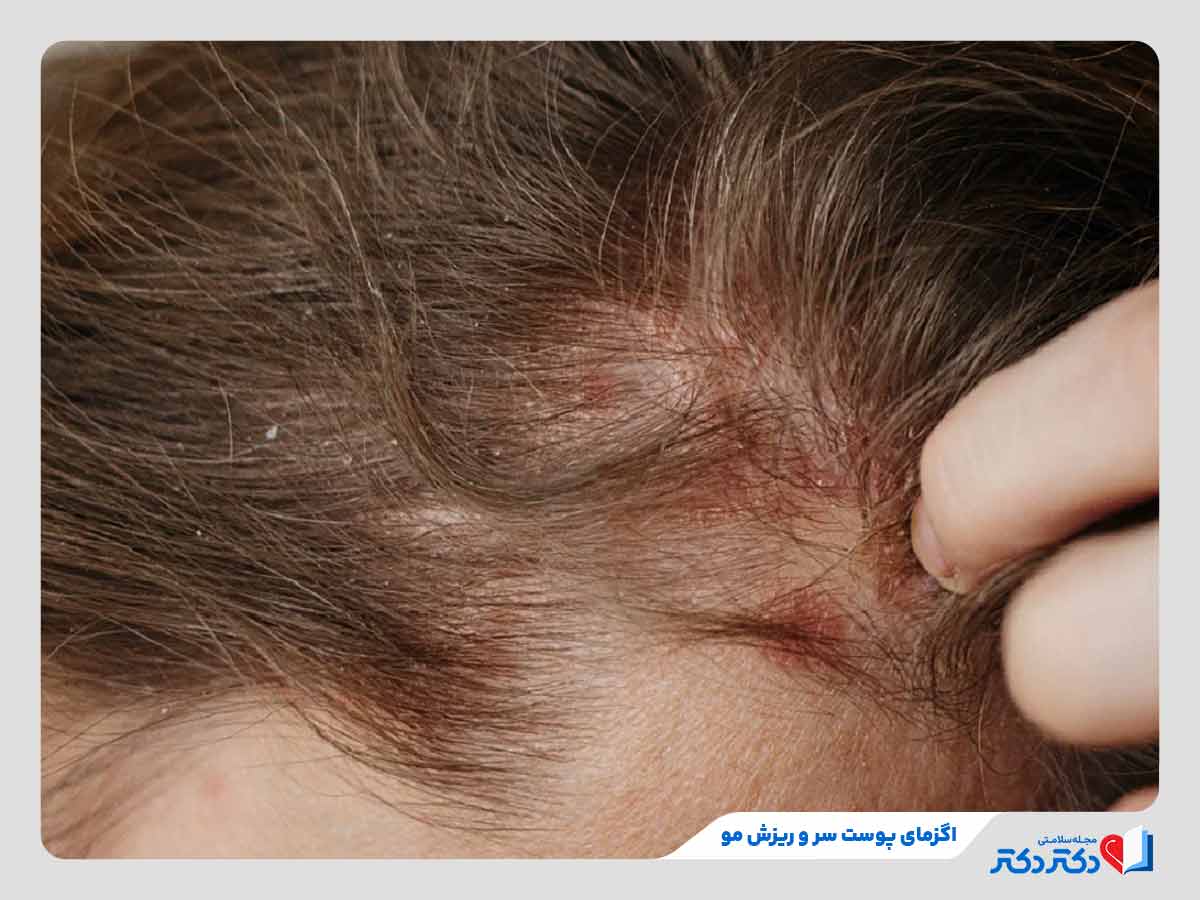 فرد مبتلا به ریزش مو در اثر اگزمای پوست سر