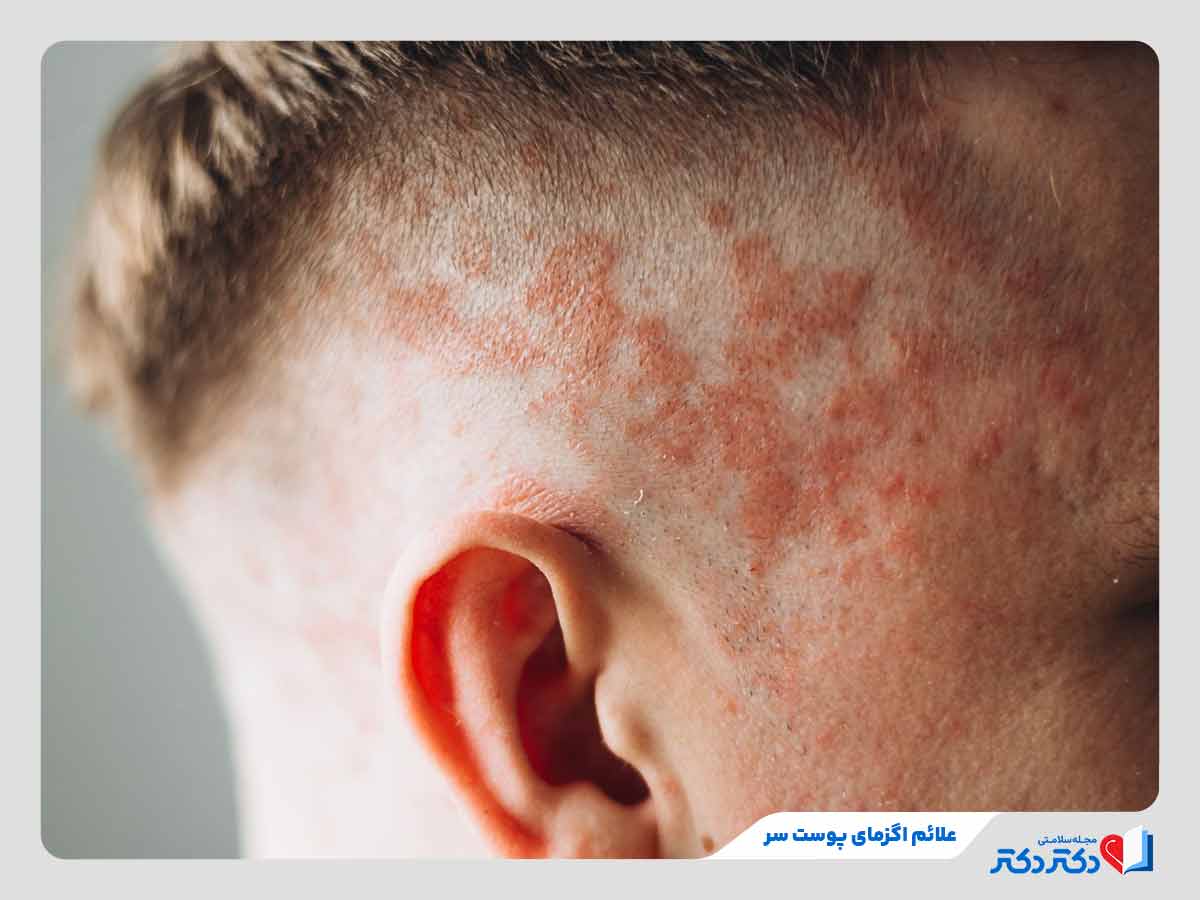 فرد مبتلا به التهاب و قرمزی پوست سر در اثر اگزمای پوست سر