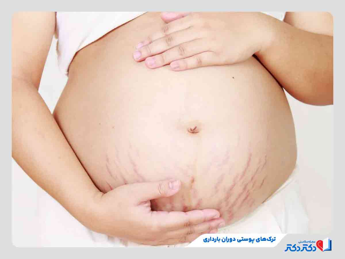 زن باردار مبتلا به ترک‌های پوستی از مشکلات پوستی دوران بارداری