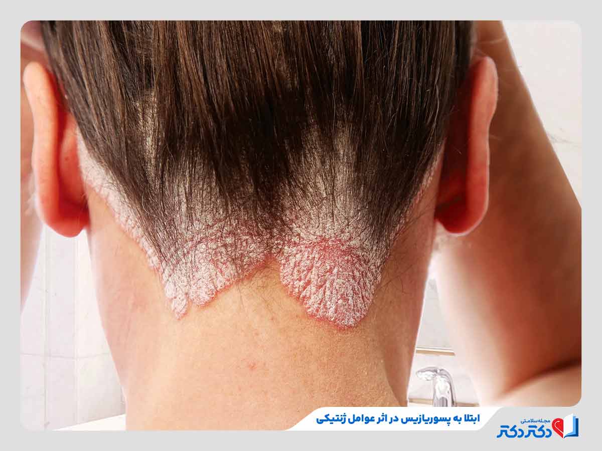 زن مبتلا به پسوریازیس به دلیل اختلالات ایمنی